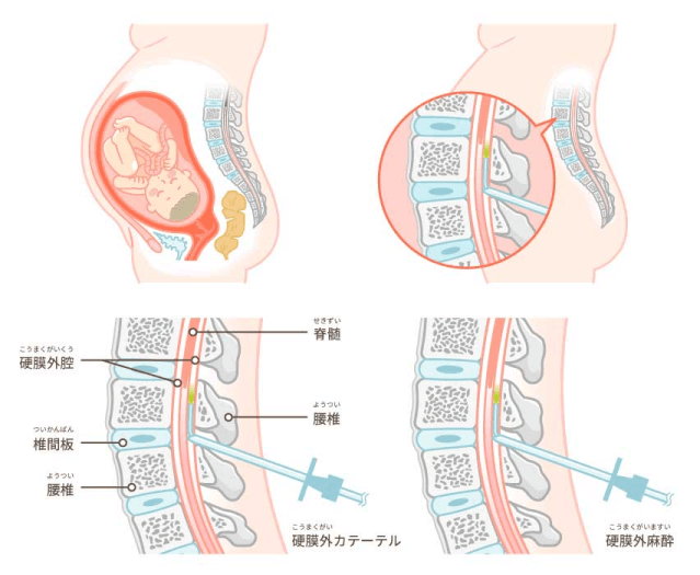 当院では硬膜外麻酔法を採用しています